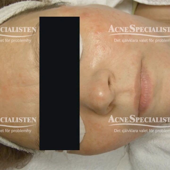 Rosacea efter behandling