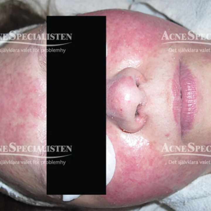 Rosacea före behandling