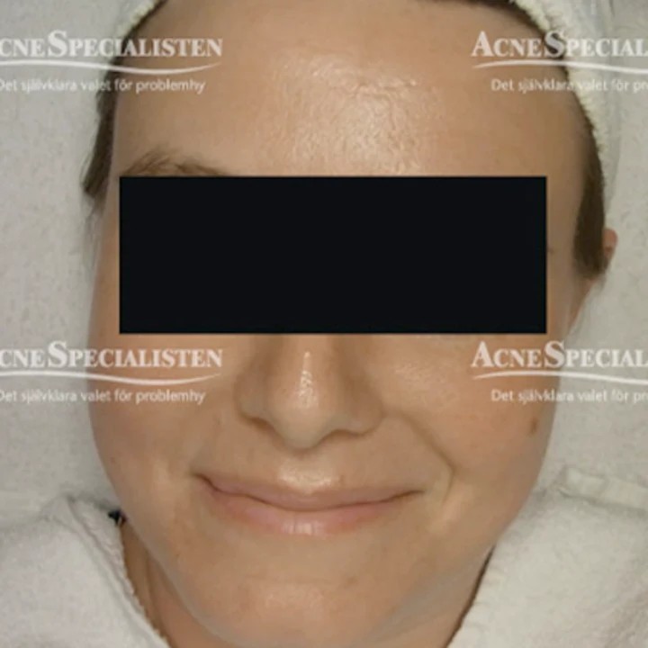 Rosacea med utslag efter behandling