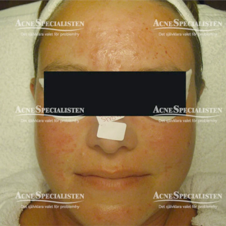 Rosacea med utslag före behandling