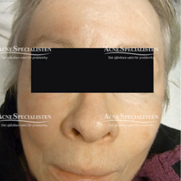 Rosacea efter behandling