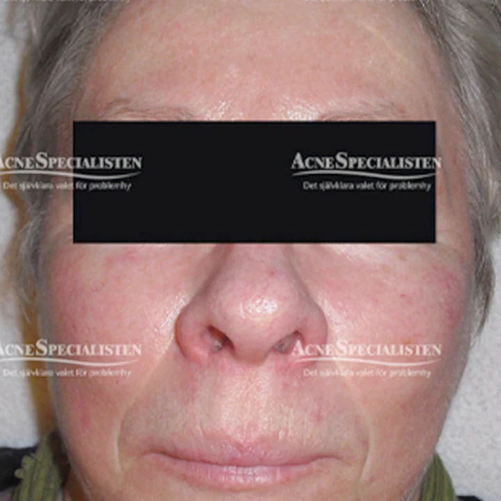 Rosacea före behandling