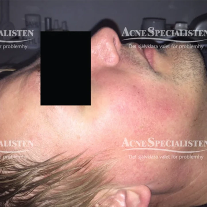 Rosacea i ansiktet efter behandling