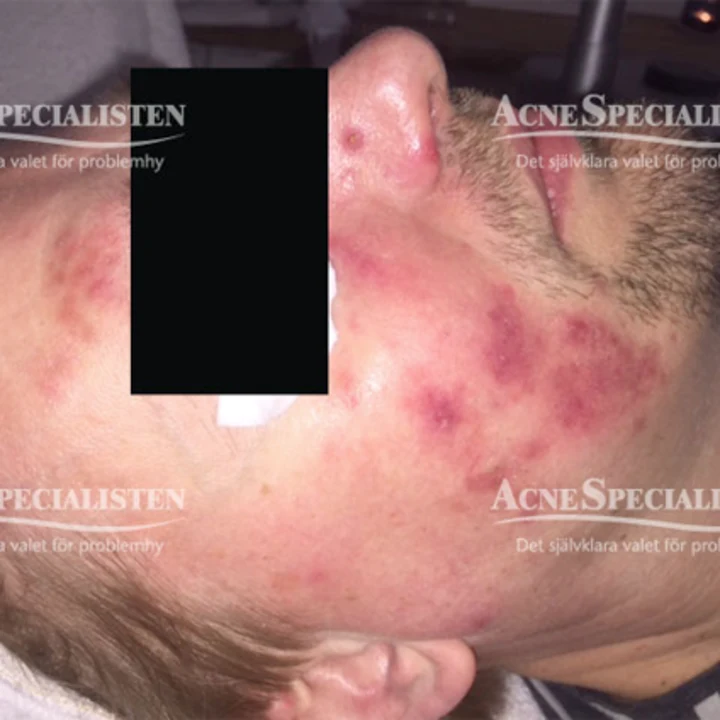 Rosacea i ansiktet före behandling
