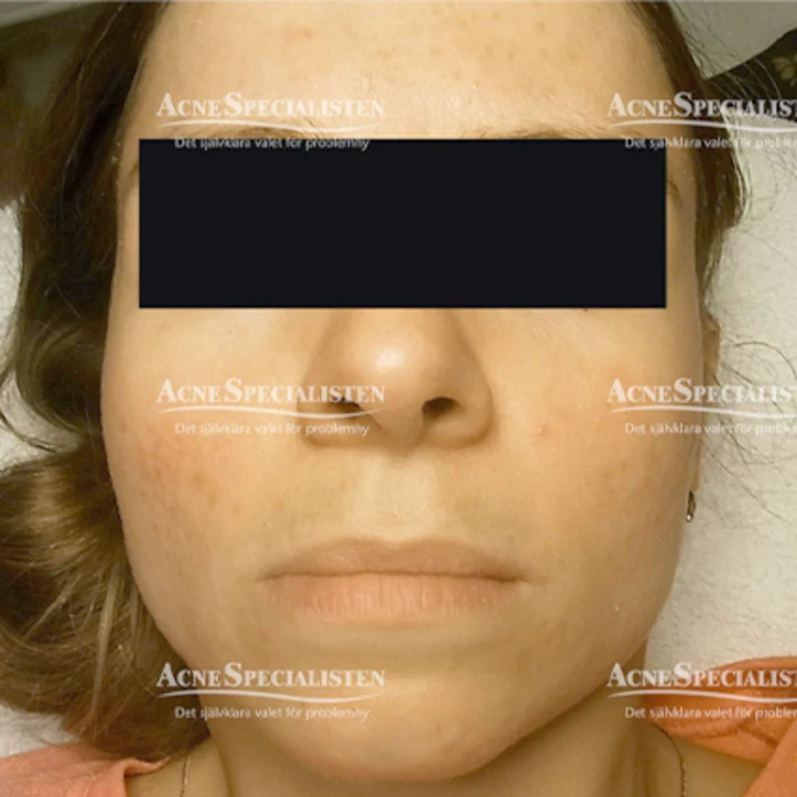 Rosacea på kinder efter behandling
