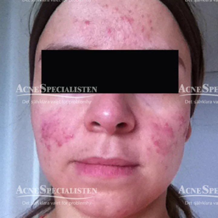 Rosacea på kinder före behandling
