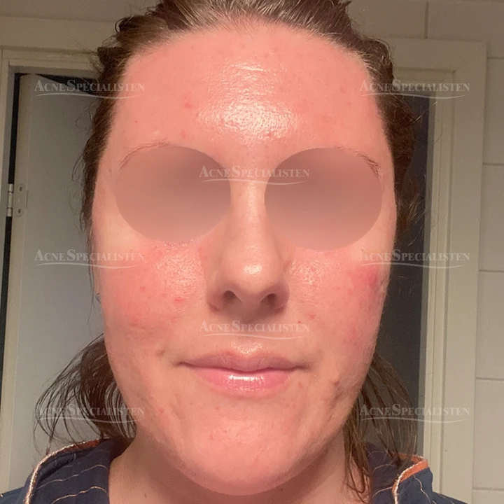 Rosacea med rodnad efter behandling