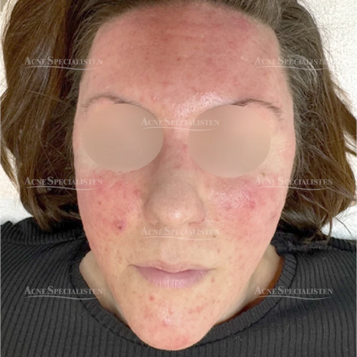 Rosacea med rodnad före behandling