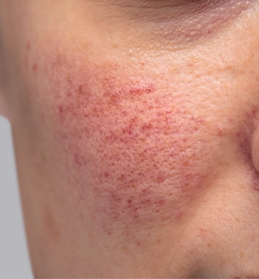 Närbild av rosacea med diffus rodnad och synliga blodkärl
